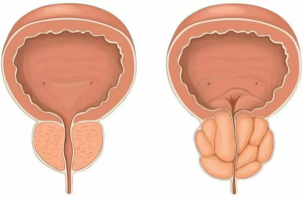 normal prostate and sick prostate